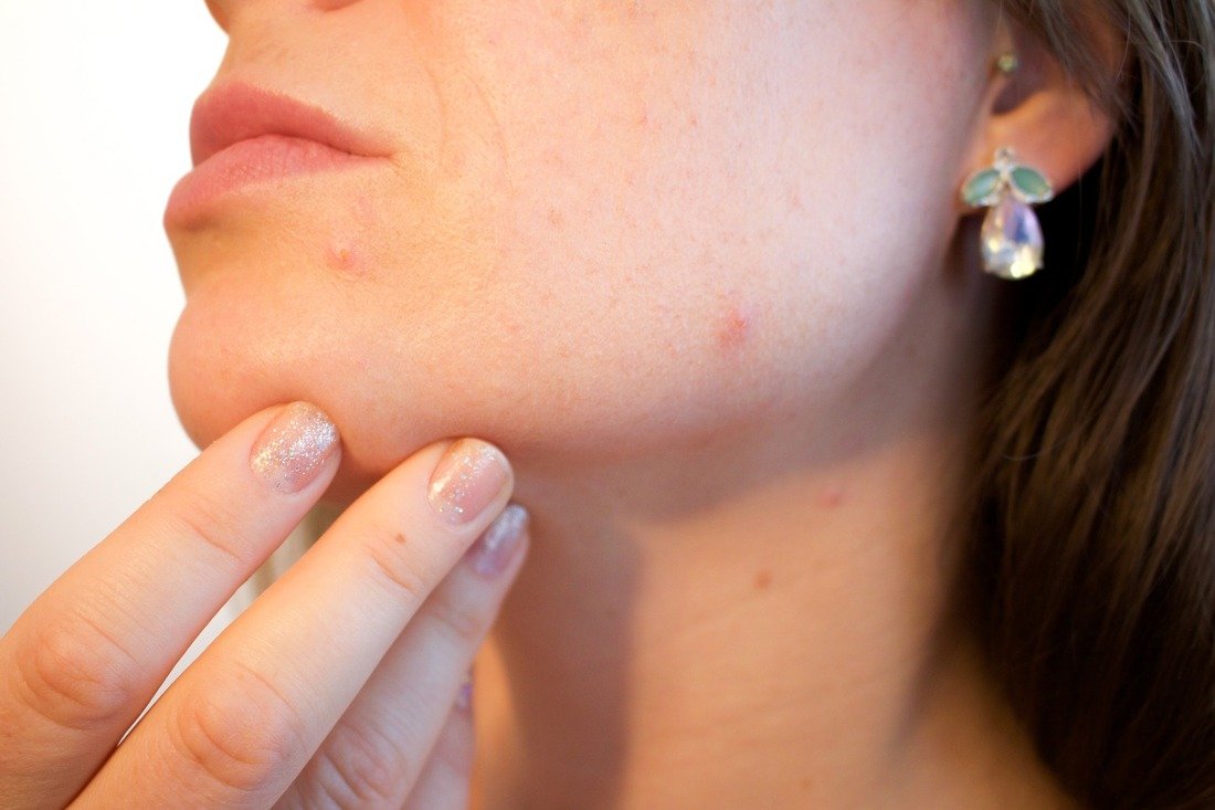 acne treatment acne removal laser removal for acne orig