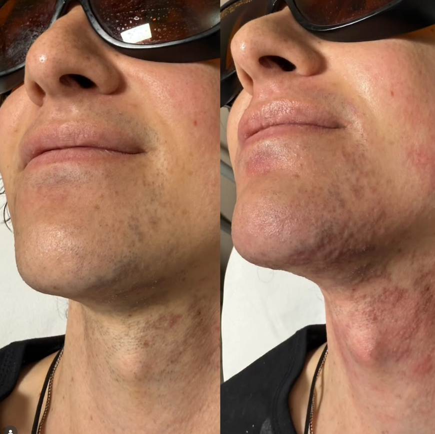 Laser Hair Removal benefits in Pleasant View