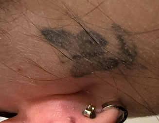Tattoo removal near me Pleasant View